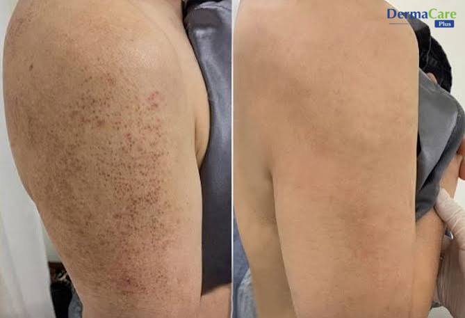 Chăm sóc da đúng cách sau khi cạo hoặc tẩy lông giúp giảm viêm nang lông và lông mọc ngược